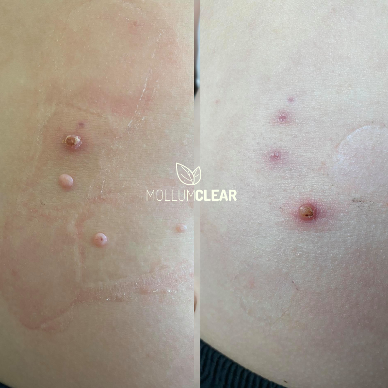 Mullcousum Rash Molluscum Contagiosum Natural treatment – Mollumclear